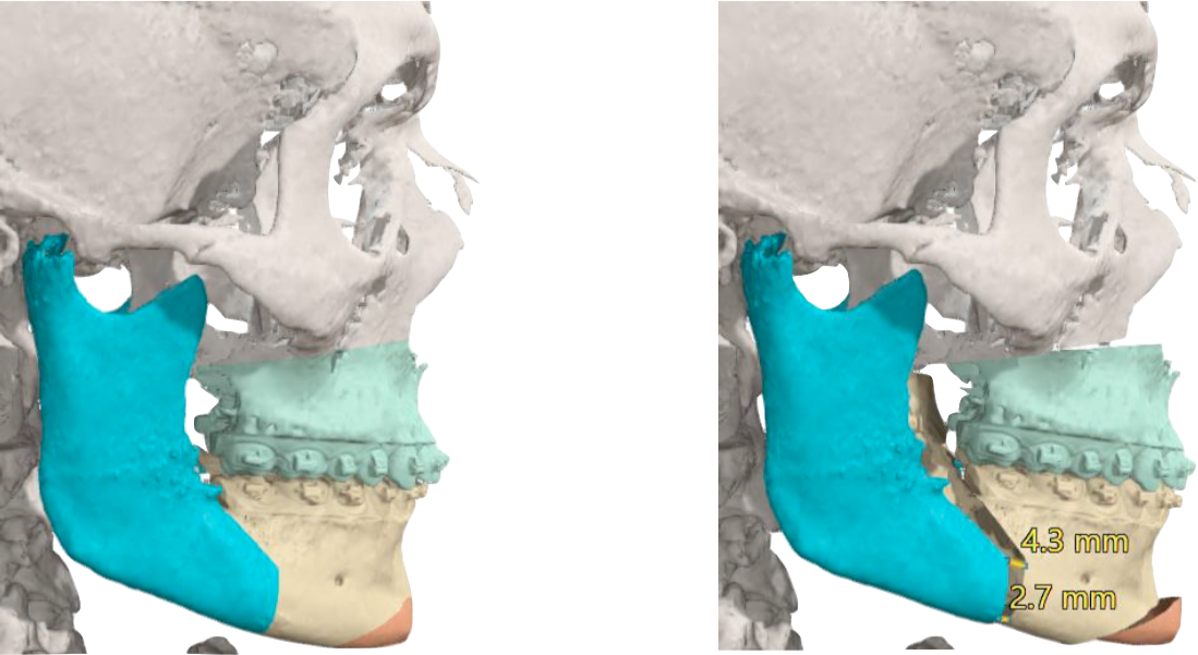 MMA Pre-Op at Stanford