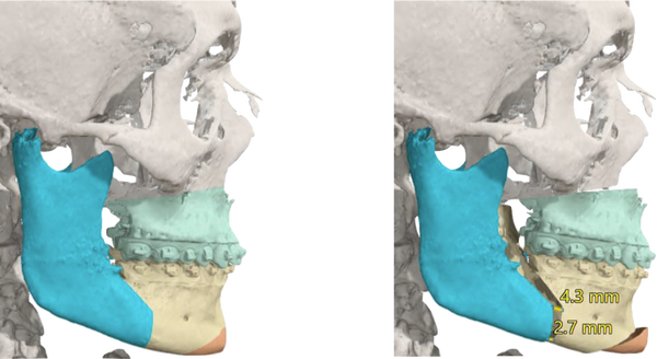 MMA Pre-Op at Stanford